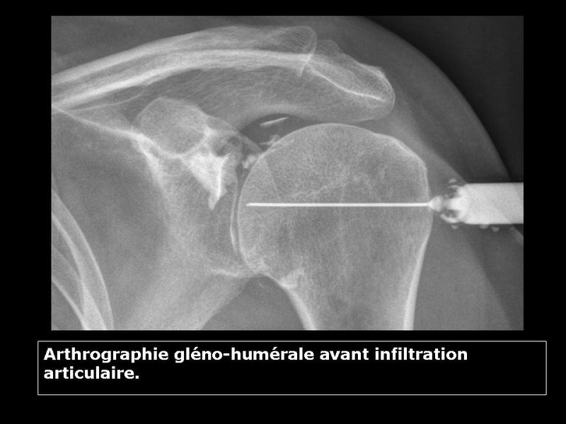 0Peut on travailler apr&egrave;s une infiltration de l&rsquo;&eacute;paule