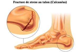 Peut on travailler avec une fracture de fatigue