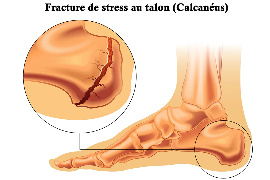 Peut on travailler avec une fracture de fatigue