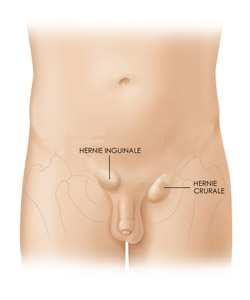 jours d'arr&ecirc;t de travail pour une hernie inguinale4